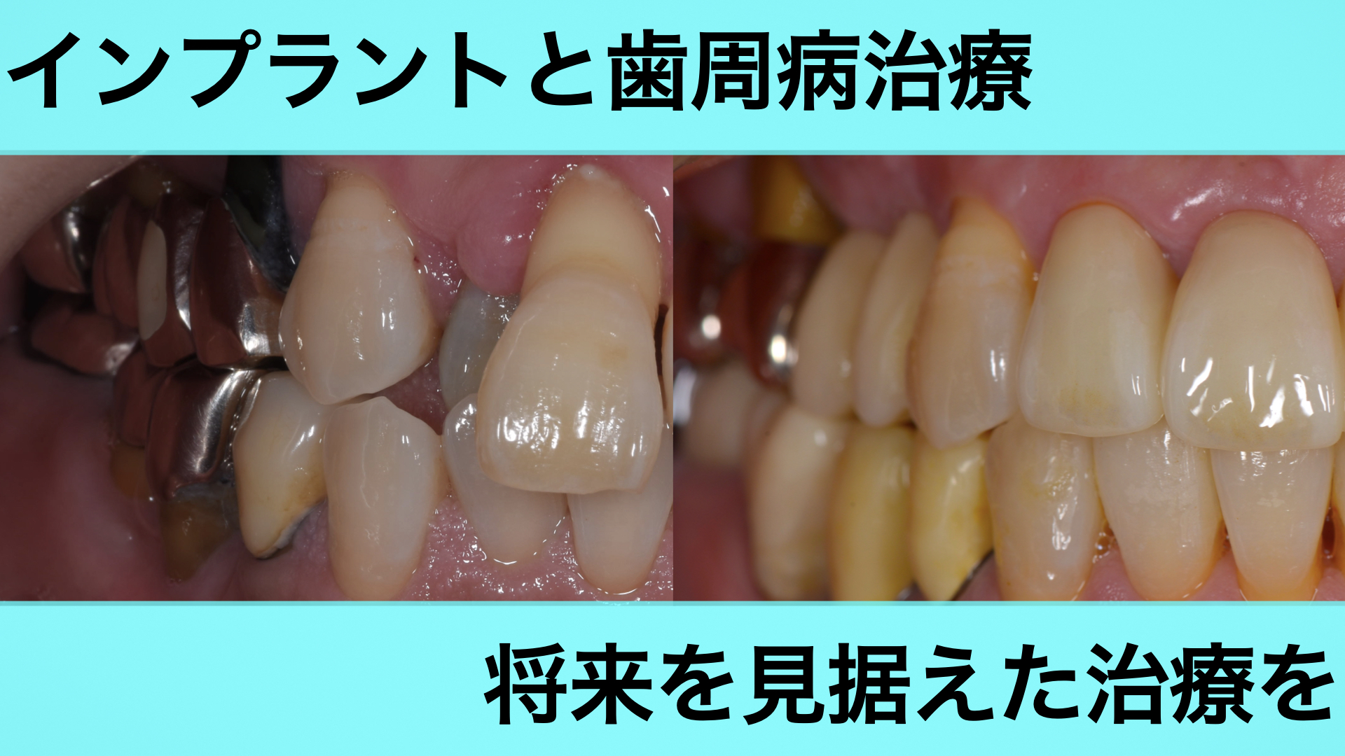 歯周病でガタガタになってしまった歯をインプラントと歯周病治療で改善した症例